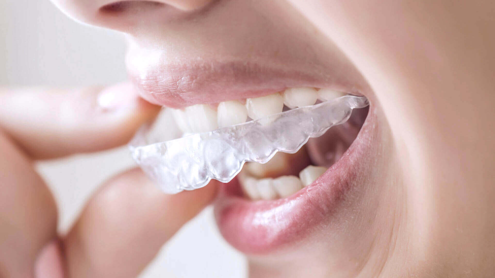 Everything You Need to Know About Orthodontics